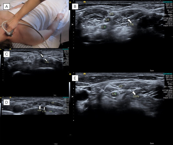 Estabilizadores escapula tempo formacion ecografia 3.jpg